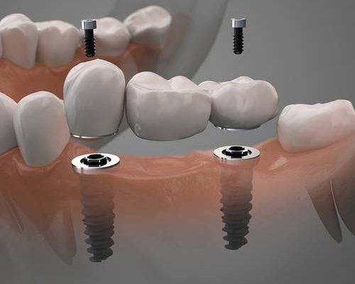 family dentist dowagiac family dentistry dowagiac mi dental implants image family dentist dowagiac family dentistry dowagiac mi dental implants image