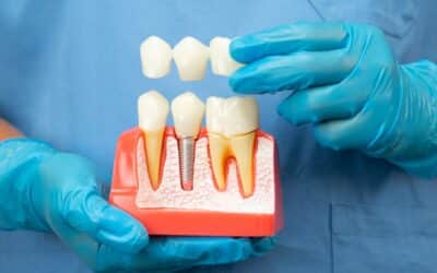 Why Dental Implants Are the Best Restorative Option for Missing Teeth