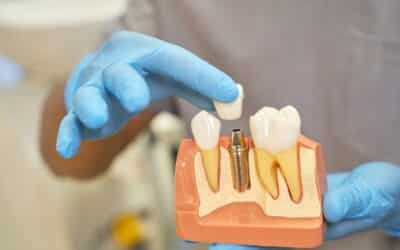 Dental Problems That Can Be Solved Using Dental Implants